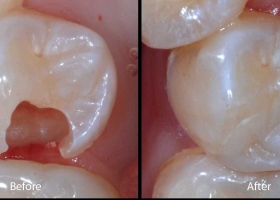 Quy trình thực hiện phục hồi răng tối ưu