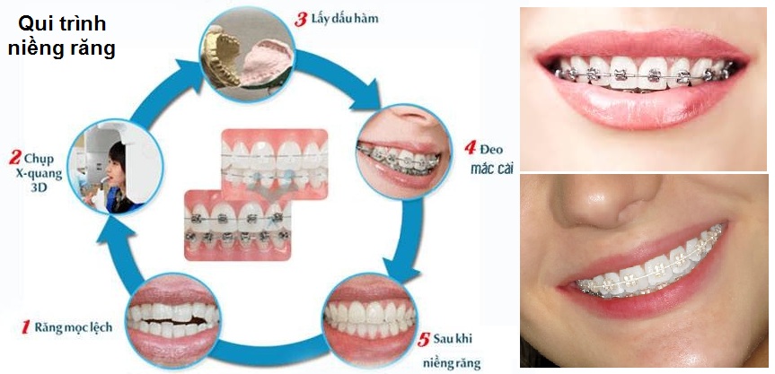 Quá trình niềng răng thay đổi theo các giai đoạn chỉnh nha 