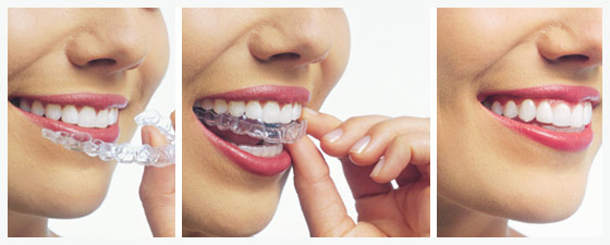 Quy trình niềng răng móm tại Nha Khoa Cường Nhân