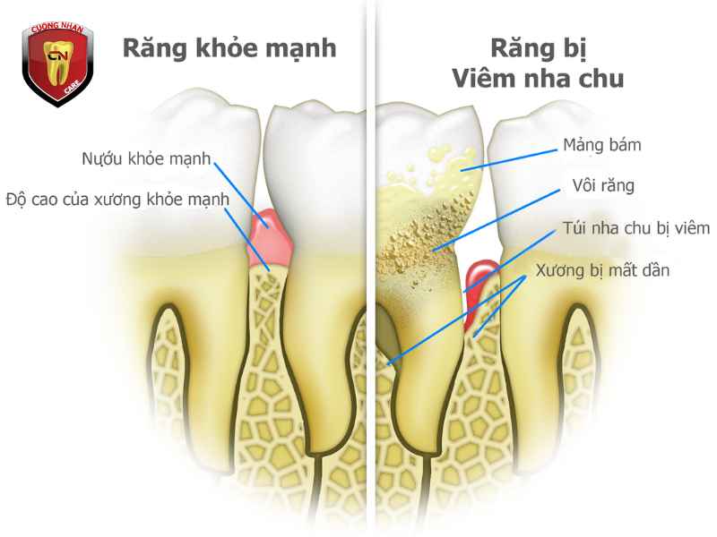 Bệnh nha chu là gì?