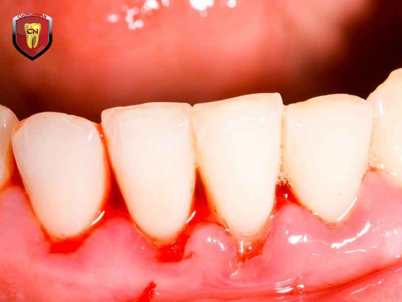 Có thể điều trị bệnh nha chu tại nhà hay không ?