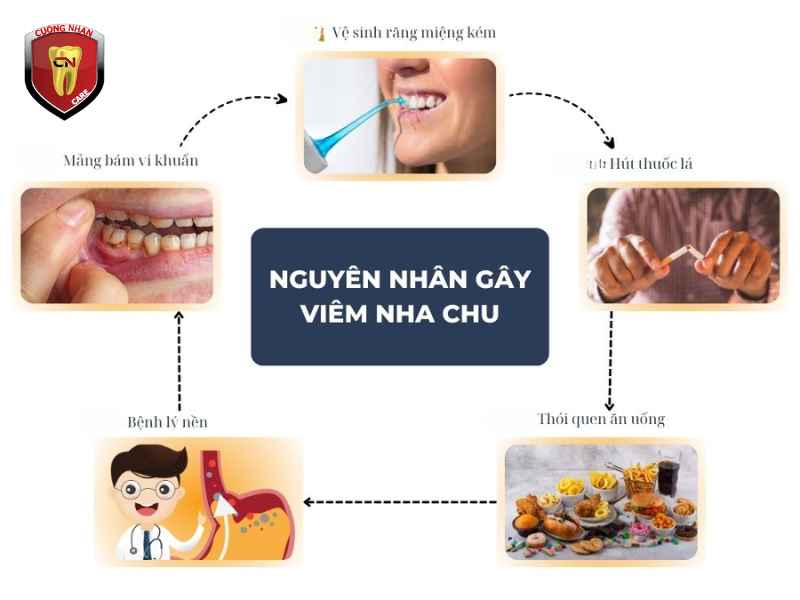 Các nguyên nhân nào gây bệnh nha chu ?
