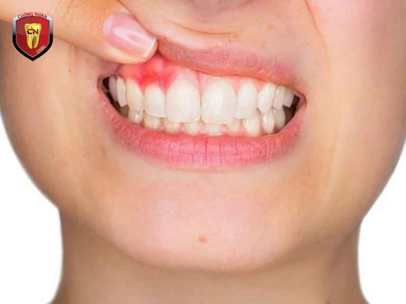 Dấu hiệu nhận biết sớm bệnh nha chu là gì ?