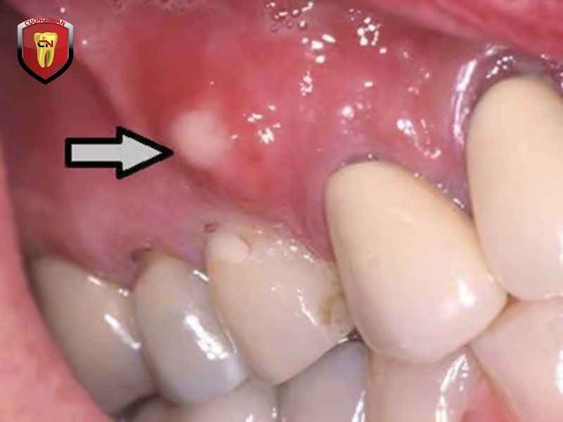 Các yếu tố nào có thể làm tăng khả năng mắc nha chu ?