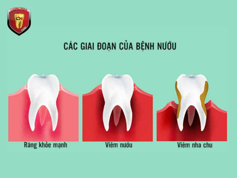 Các giai đoạn tiến triển bệnh nha chu