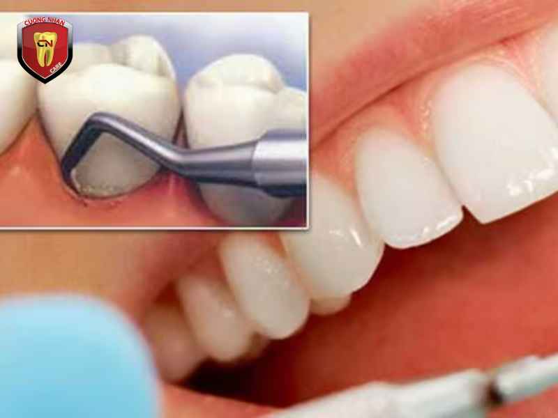 Quy trình khám bệnh nha chu sẽ như thế nào ?