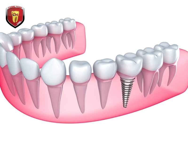 Phương pháp cấy ghép Implant nghĩa là gì ?