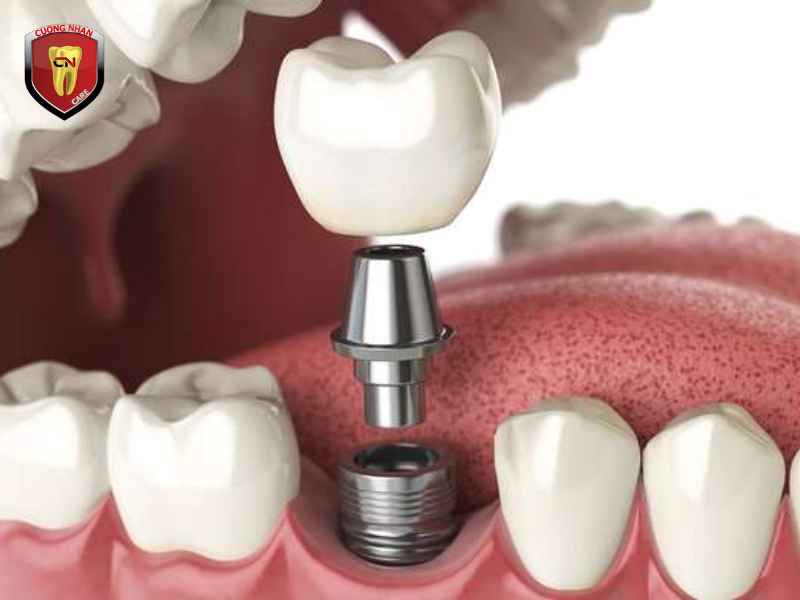 Cấy ghép Implant có thực sự tốt không ?