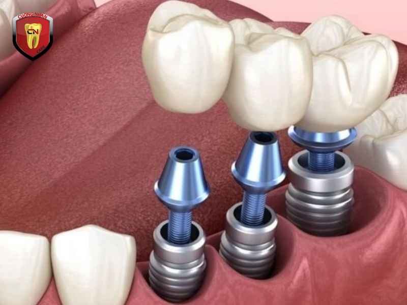 Các phương pháp cấy ghép Implant phổ biến hiện nay