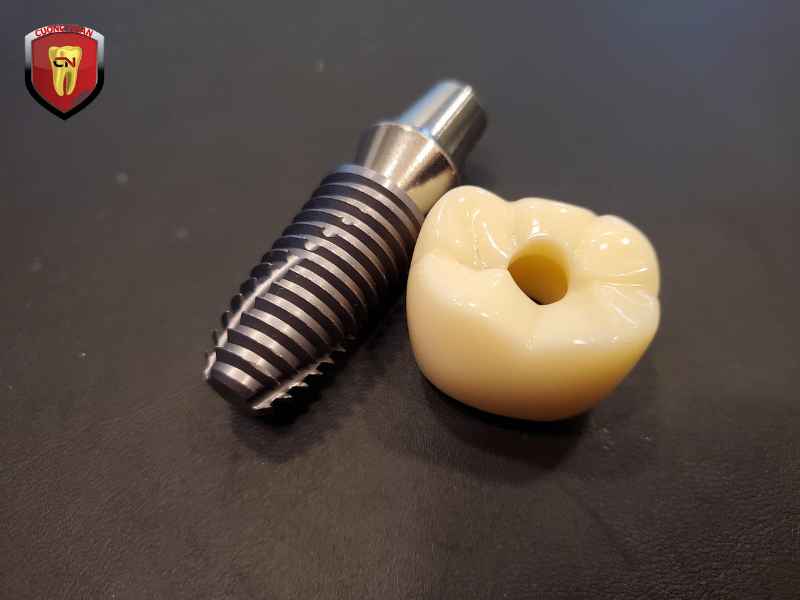 Tại sao nên chọn Nha Khoa Cường Nhân để cấy Implant?