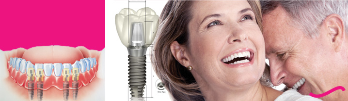 Phương pháp cấy ghép Implant đặc biệt dành cho người mất toàn bộ răng