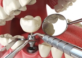 Quy trình thực hiện niềng răng hiệu quả và an toàn