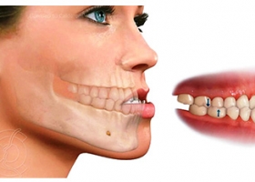 Quy trình phục hồi răng
