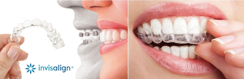 * Niềng răng không mắc cài Clear aligner được sản xuất tại Việt Nam.