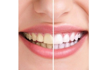 Sự khác biệt khi thực hiện tẩy trắng răng