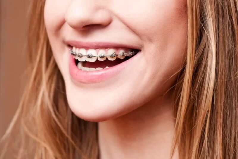 Niềng răng mắc cài là gì? Làm sao để chọn loại phù hợp? Niềng răng mắc cài là gì? Làm sao để chọn loại phù hợp?