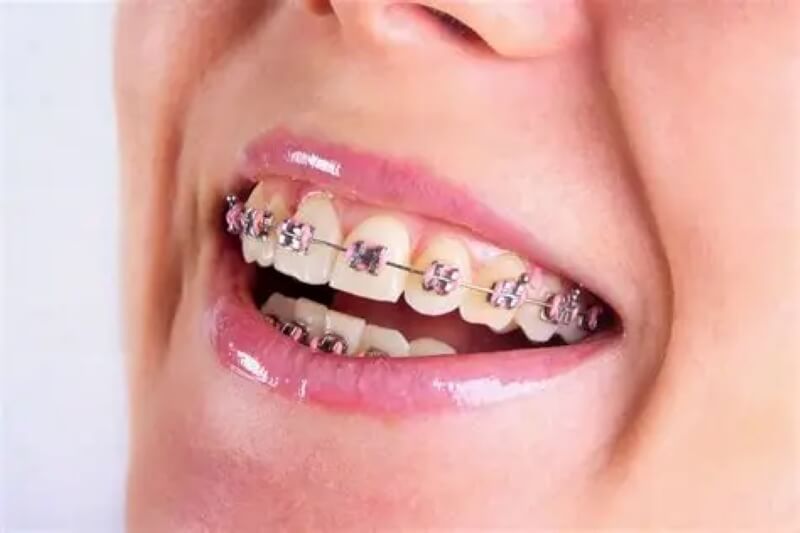 Niềng răng mắc cài kim loại Niềng răng mắc cài kim loại
