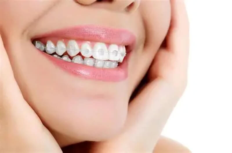 Niềng răng mắc cài sứ/Pha lê Niềng răng mắc cài sứ/Pha lê
