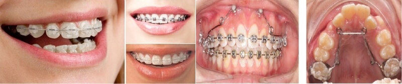 Quy trình niềng răng mắc cài chuẩn y khoa Quy trình niềng răng mắc cài chuẩn y khoa