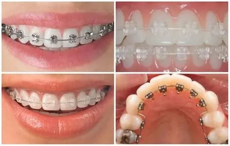 Lưu ý & kinh nghiệm khi niềng răng mắc cài Lưu ý & kinh nghiệm khi niềng răng mắc cài