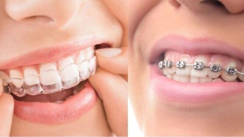 Các lưu ý quan trọng khi niềng răng không mắc cài