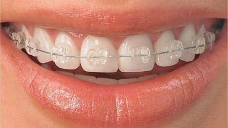 Dịch vụ niềng răng không mắc cài tại Nha Khoa Cường Nhân