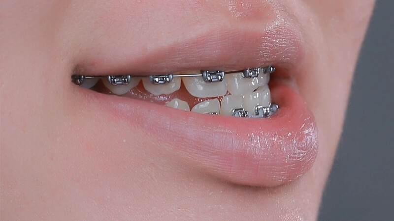 Các phương pháp giúp cải thiện tình trạng móm răng Các phương pháp giúp cải thiện tình trạng móm răng