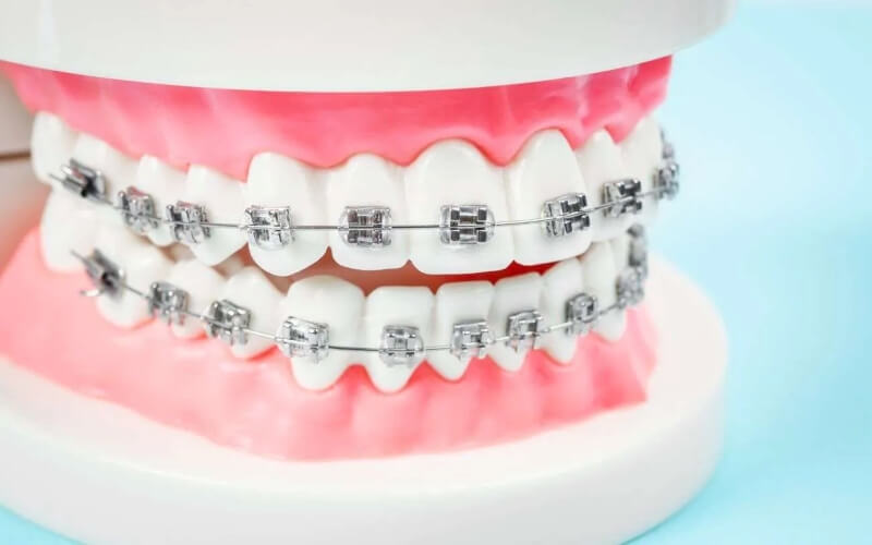 Các phương pháp niềng răng móm phổ biến hiện nay Các phương pháp niềng răng móm phổ biến hiện nay