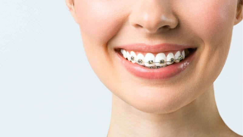 Niềng răng móm mất bao lâu? Có đau không? Niềng răng móm mất bao lâu? Có đau không?