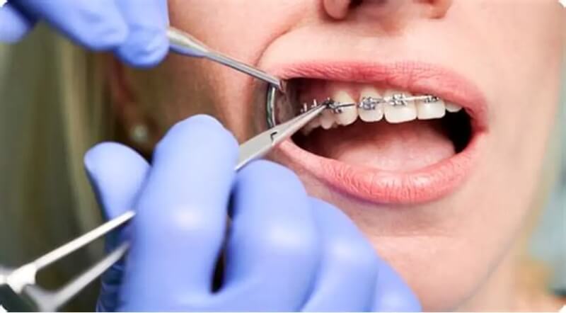 Lưu ý & kinh nghiệm khi niềng răng móm Lưu ý & kinh nghiệm khi niềng răng móm