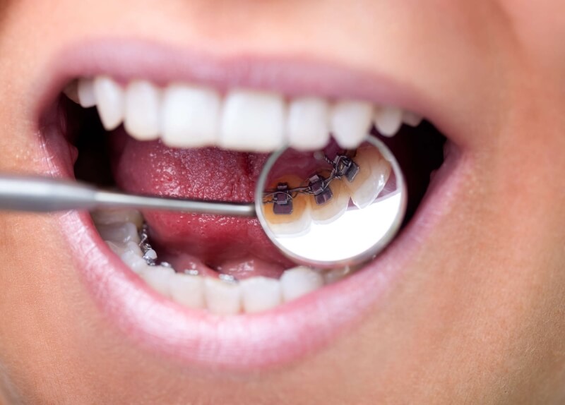 Niềng răng móm ở đâu tốt? Niềng răng móm ở đâu tốt?