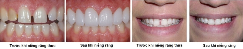 Hình ảnh trước – sau niềng răng thưa