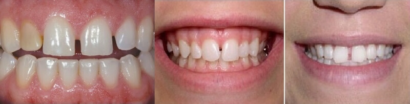 Nguyên nhân gây ra tình trạng răng thưa