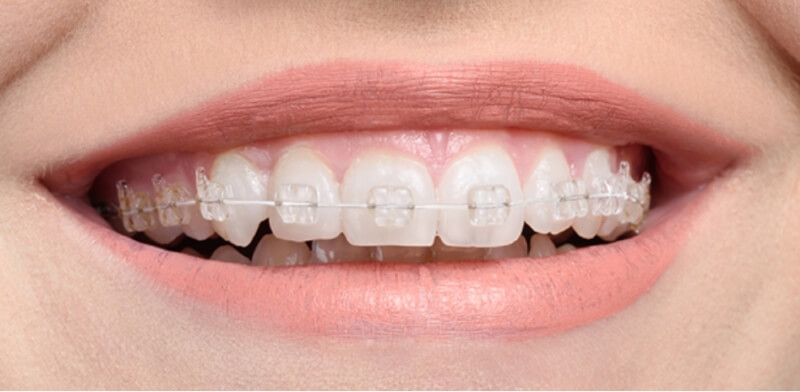 Niềng mắc cài tự buộc