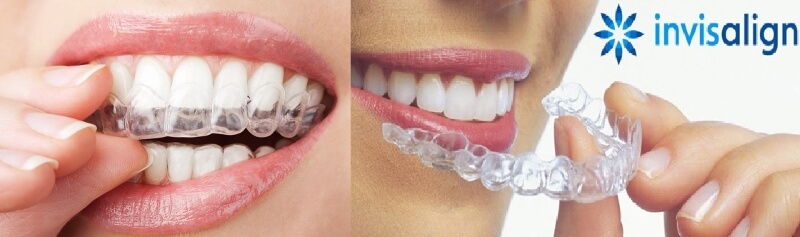 Niềng răng thưa mất bao lâu? Có đau không?