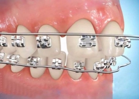 Hình ảnh thực tế về niếng răng