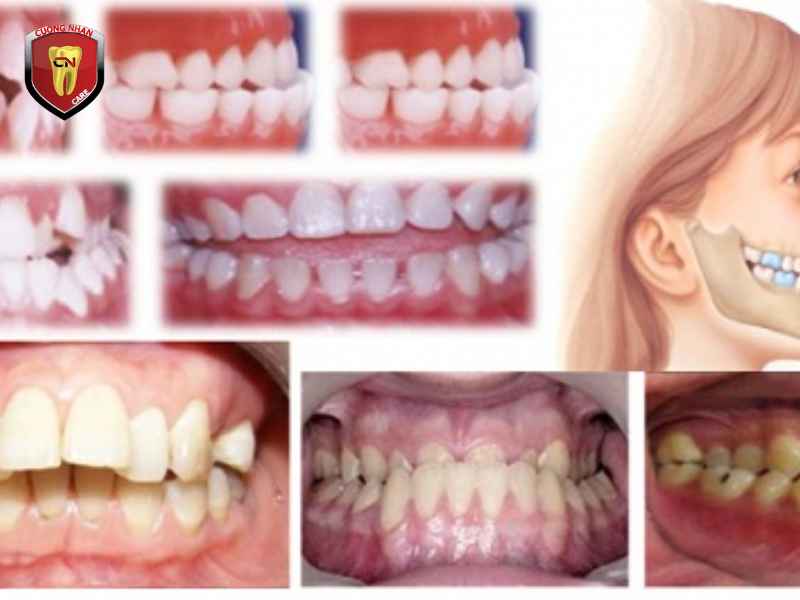 Trường hợp chống chỉ định phục hình răng sứ