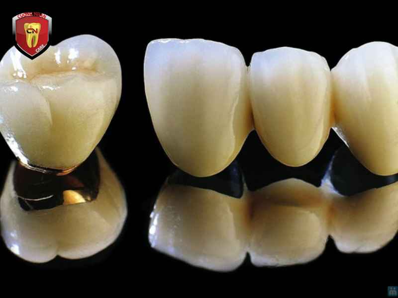 Các loại răng sứ phổ biến hiện nay