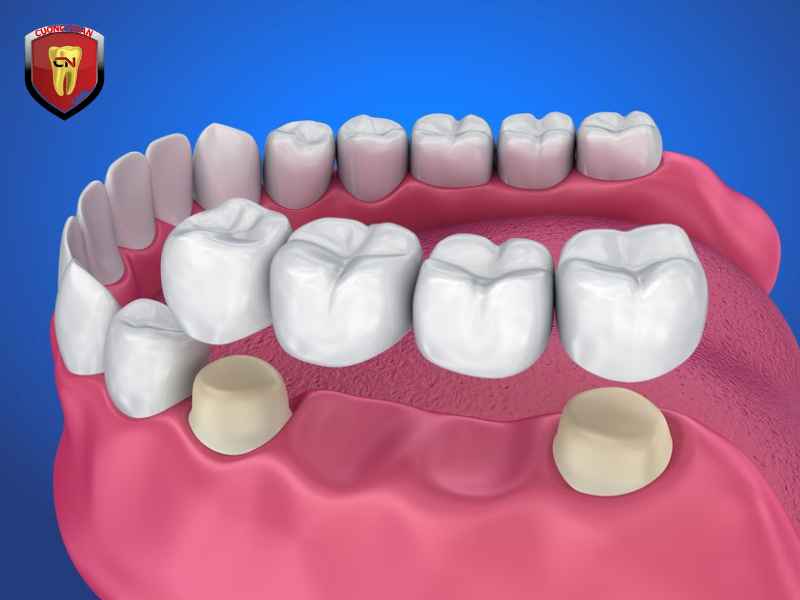 Quy trình phục hình răng sứ chuẩn nha khoa