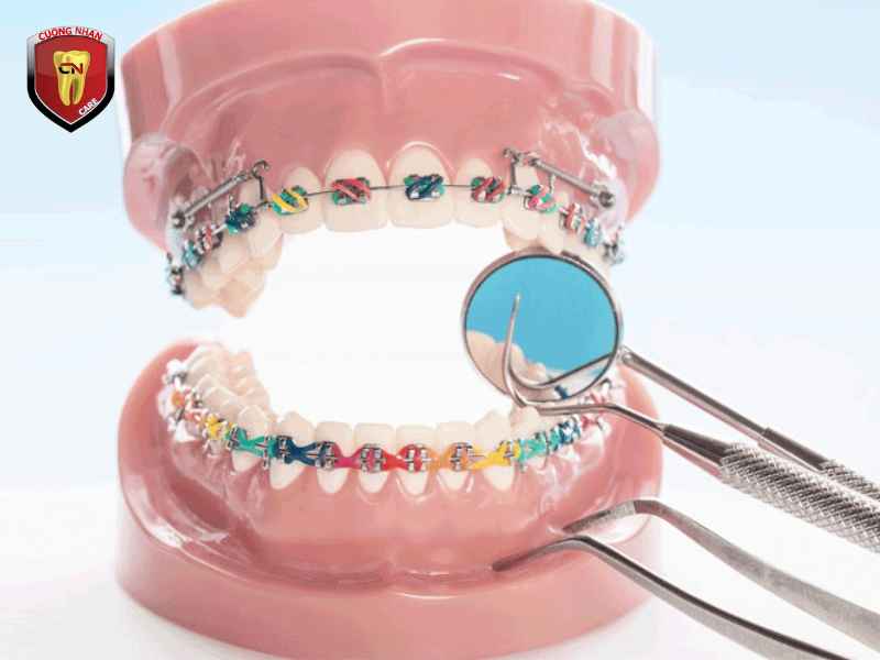 Nha khoa Cường Nhân - phục hình răng sứ uy tín tại Bình DƯƠNG