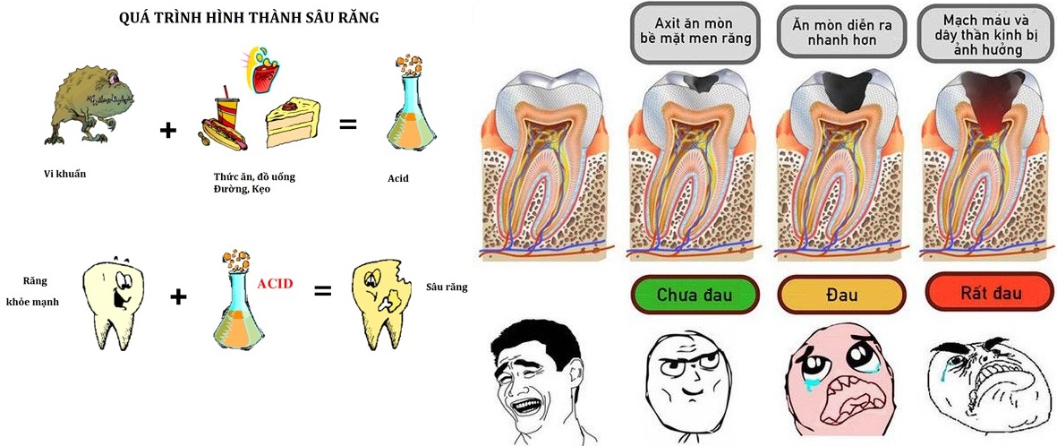 Quá trình sâu răng diễn ra như thế nào