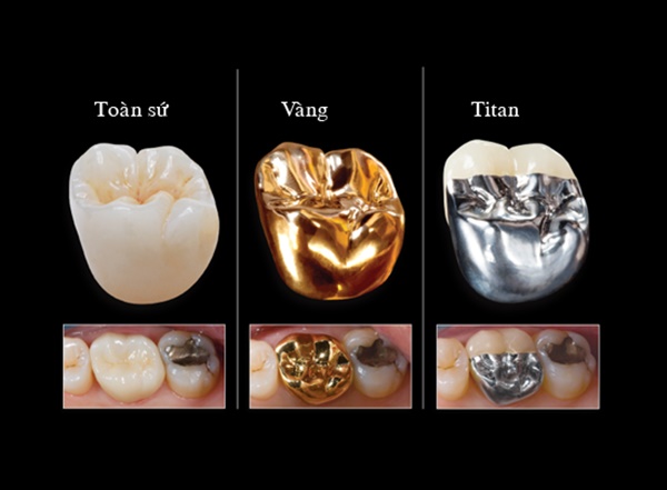 Răng sứ được chế tạo bởi vật liệu gì