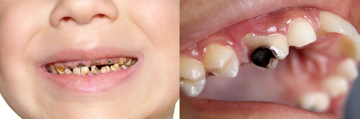 Những lệch lạc thường thấy nơi răng trẻ em và chỉnh nha phòng ngừa 