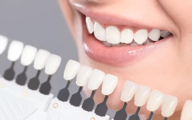 Có nên tẩy trắng răng không?