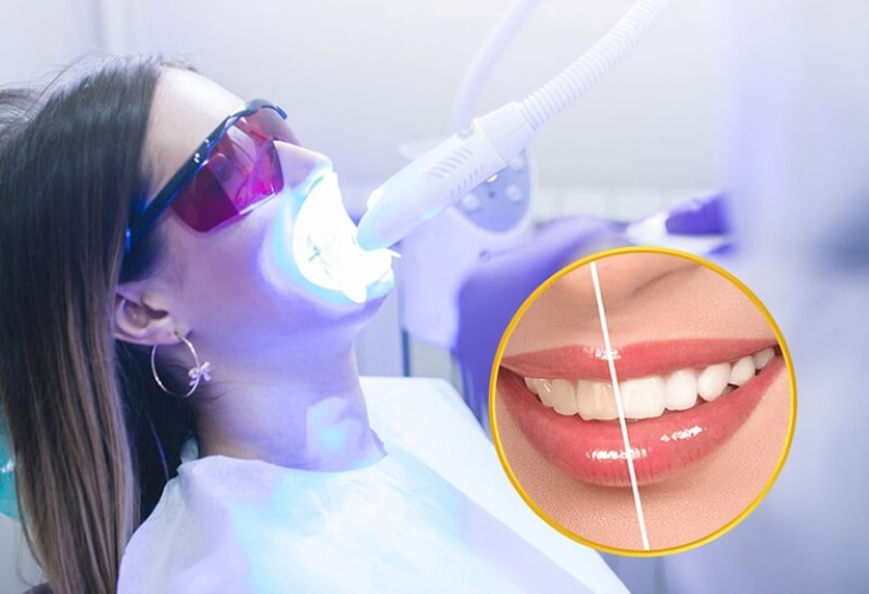 Các phương pháp tẩy trắng răng phổ biến