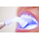 Tẩy trắng răng tối ưu và hiệu quả nhất