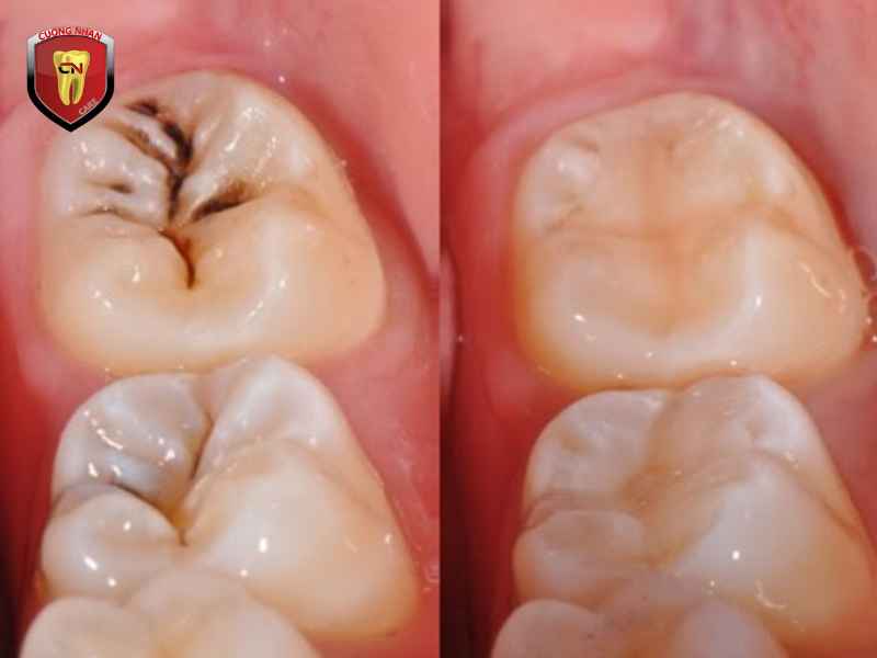Khi nào người bệnh cần phải trám răng?