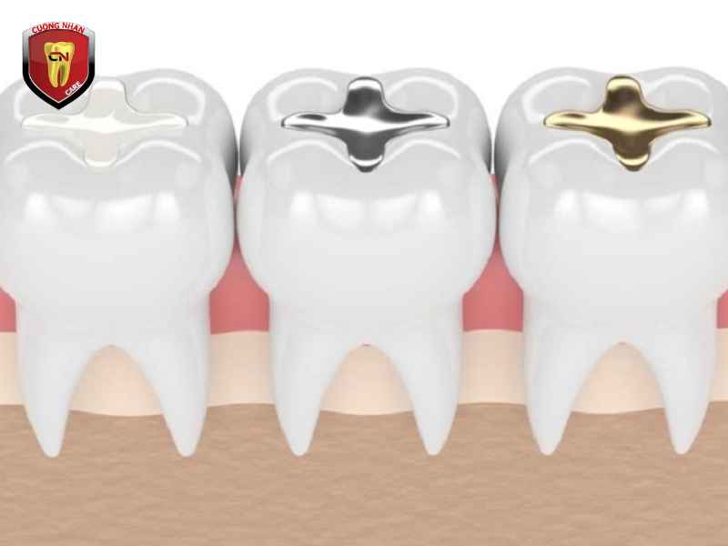 Các loại trám răng & vật liệu phổ biến