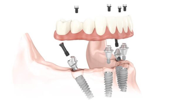 Đôi nét về kỹ thuật trồng răng Implant All On 4