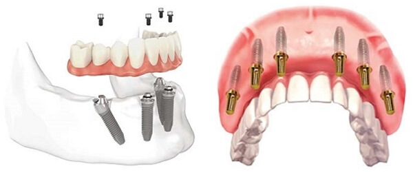 Ưu nhược điểm của trồng răng Implant All On 4
